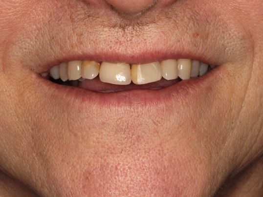 implant after photo