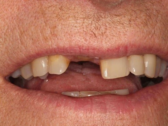 implant before photo