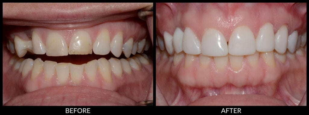 veneers before and after photo