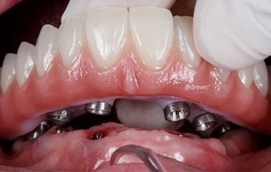 all-on-4 implant photo