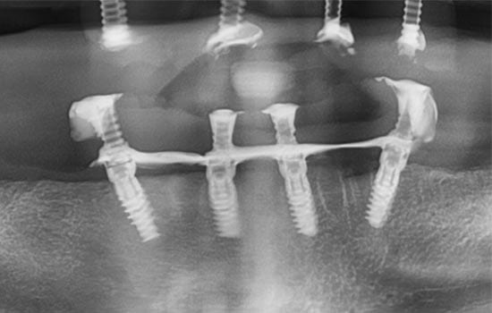 all-on-4 implant xray