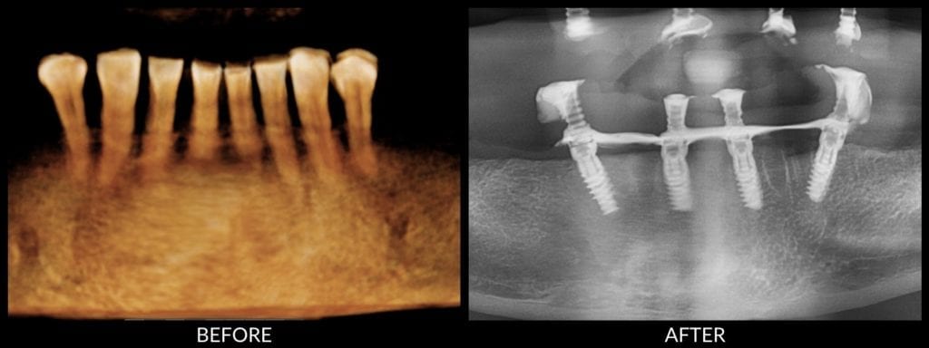 all-on-4 implants before and after photo