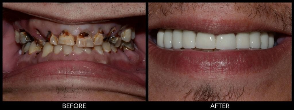all-on-4 dental implants before and after photo