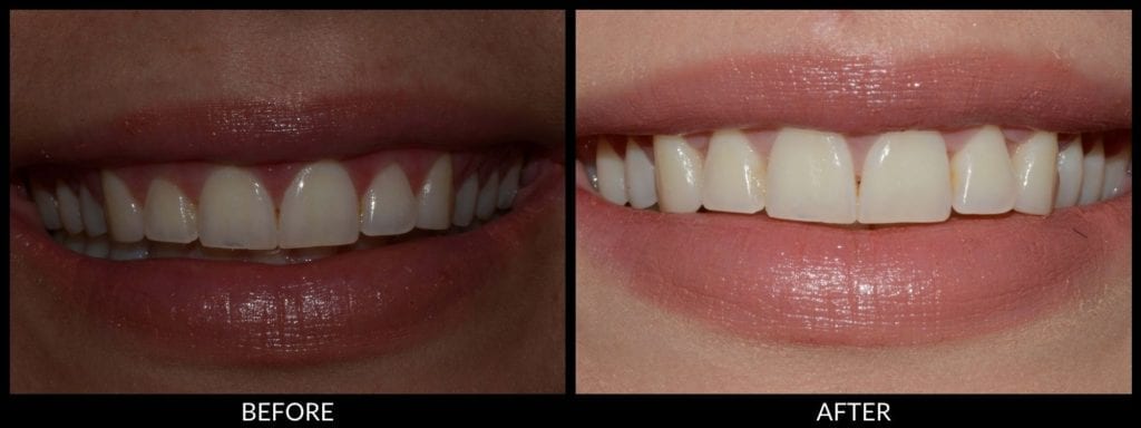 crown lengthening before and after photo