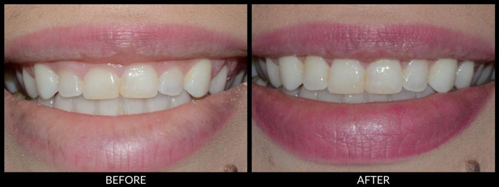 crown lengthening before and after photo