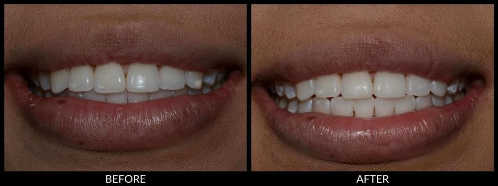 dental bonding before and after photo