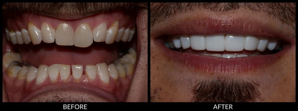 dental bonding before and after photo
