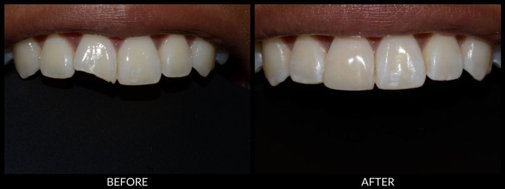 dental bonding before and after photo