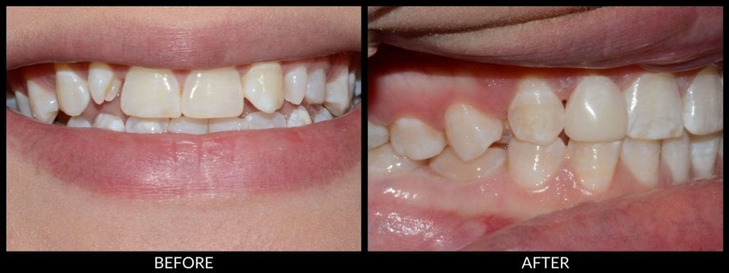 dental bonding before and after photo
