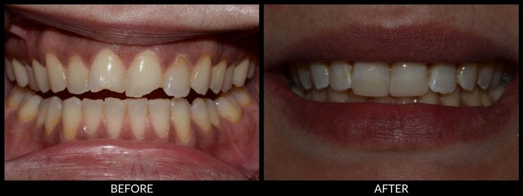 dental bonding before and after photo
