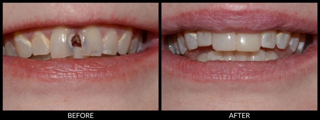 dental bonding before and after photo