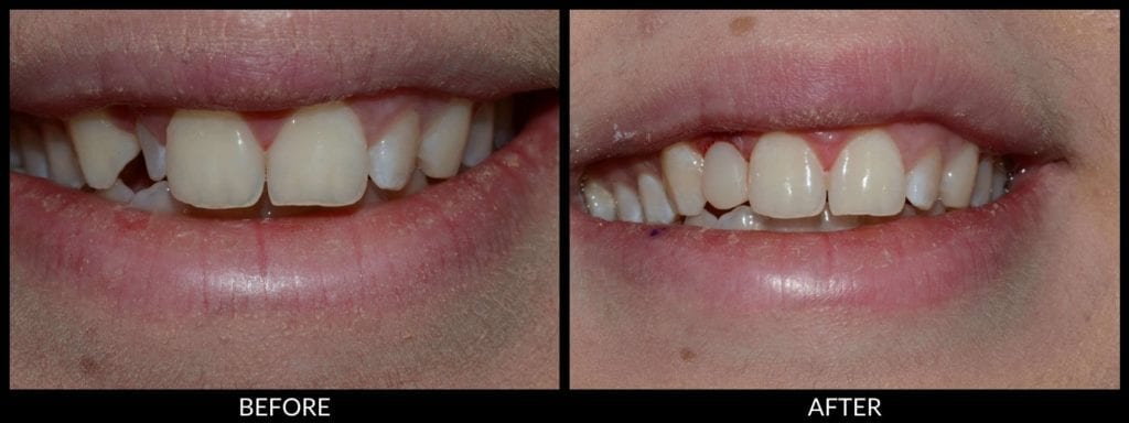 dental bonding before and after photo