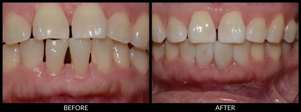 dental bonding before and after photo