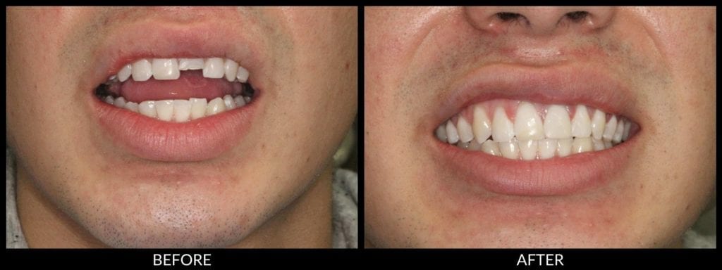dental bonding before and after photo