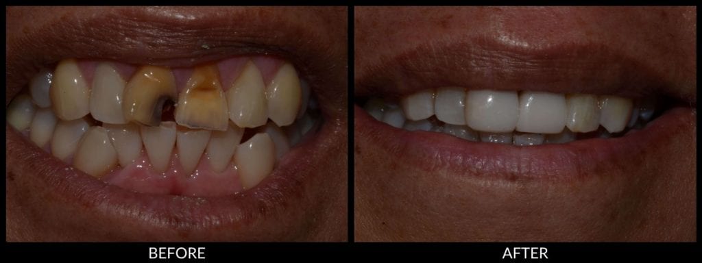 dental bonding before and after photo