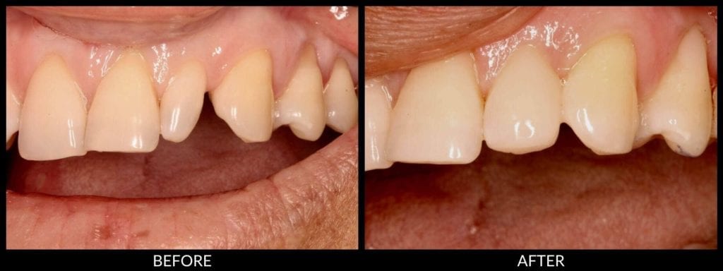 dental bonding before and after photo