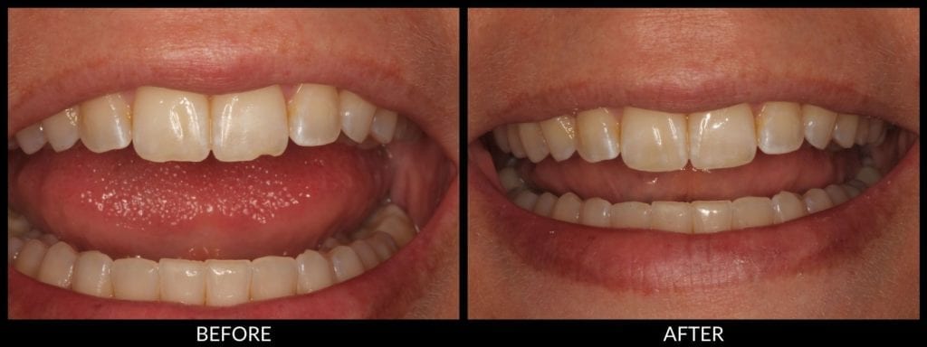dental bonding before and after photo