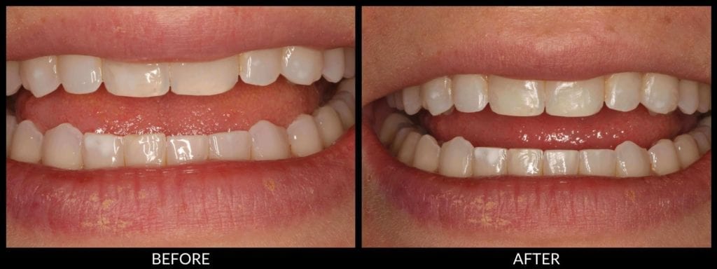 dental bonding before and after photo