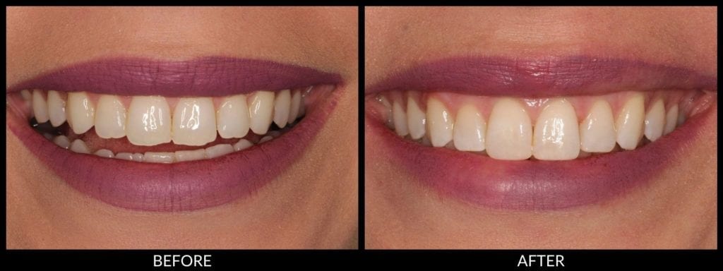 dental bonding before and after photo