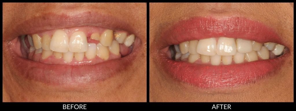 dental bonding before and after photo
