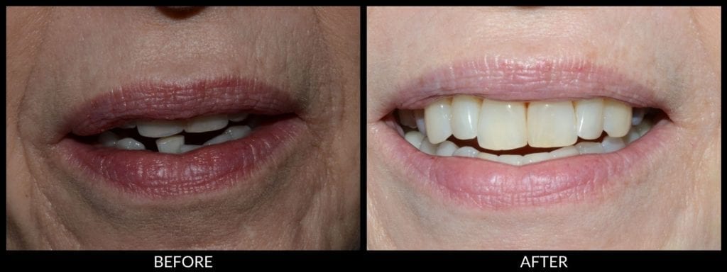 dental bridge before and after photo
