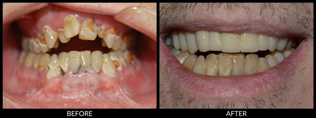 dental bridge before and after photo