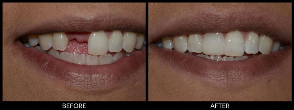 dental bridge before and after photo