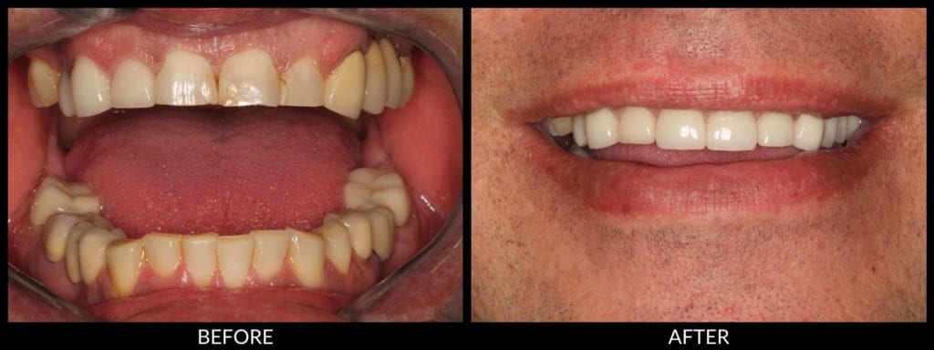 dental crowns before and after photo