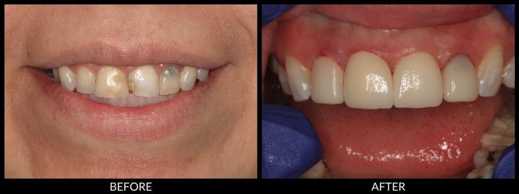 dental crowns before and after photo