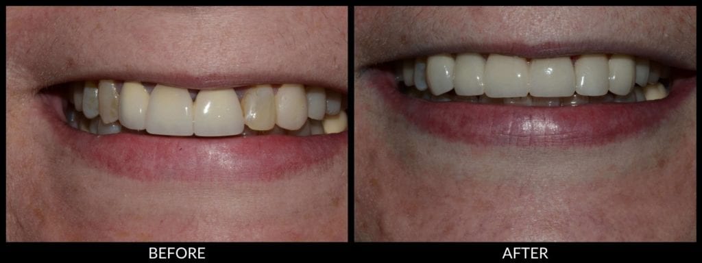 dental crowns before and after photo