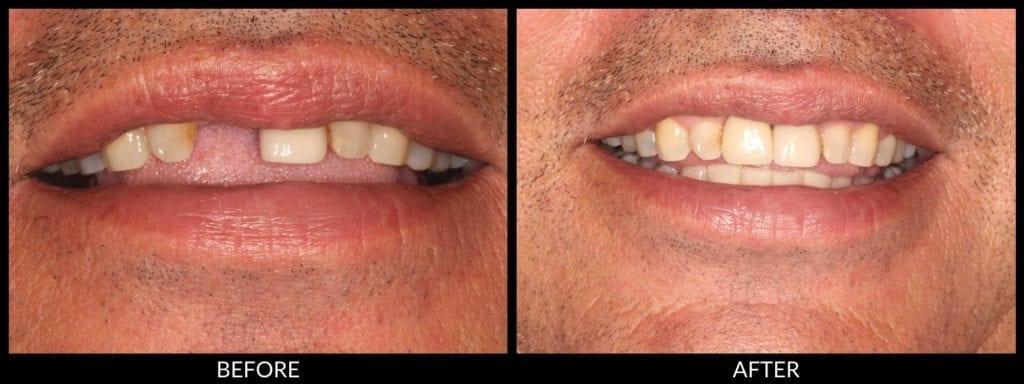 dental implants before and after photo