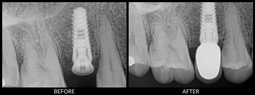 dental implants before and after xray