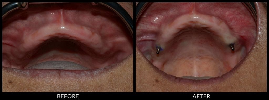 dental implants before and after photo