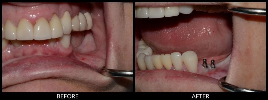 dental implants before and after photo