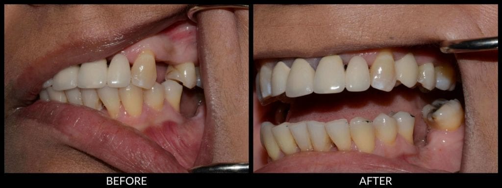 dental implants before and after photo