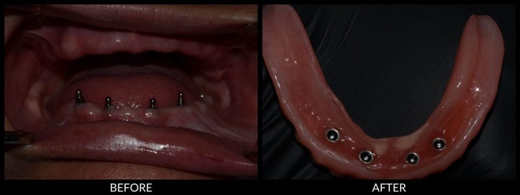 dental implants before and after photo
