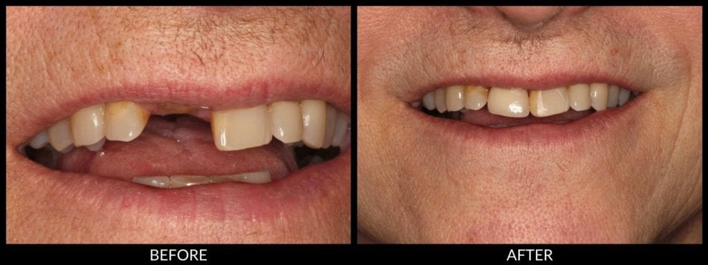 dental implants before and after photo