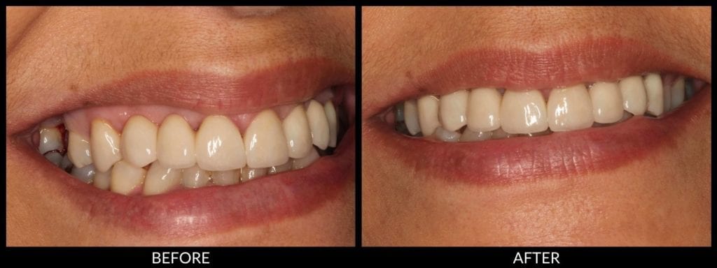 dental implants before and after photo