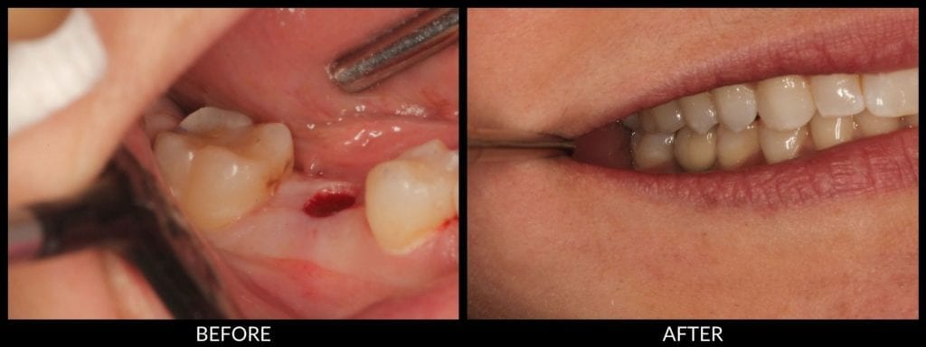 dental implants before and after photo