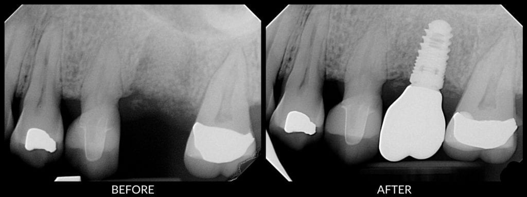 dental implants before and after xrays