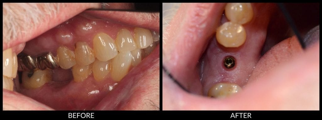 dental implants before and after photo