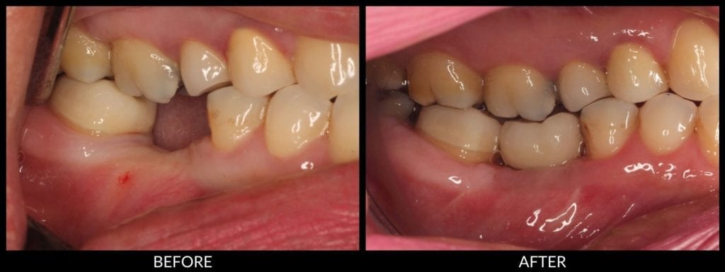 dental implants before and after photo