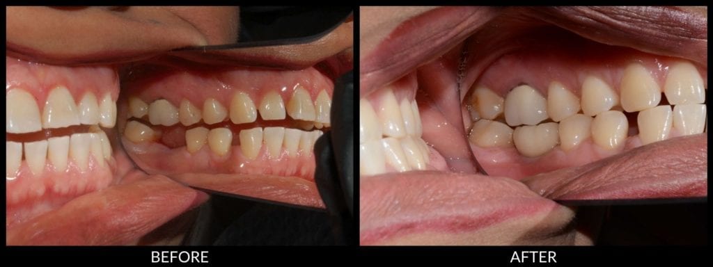 dental implants before and after photo