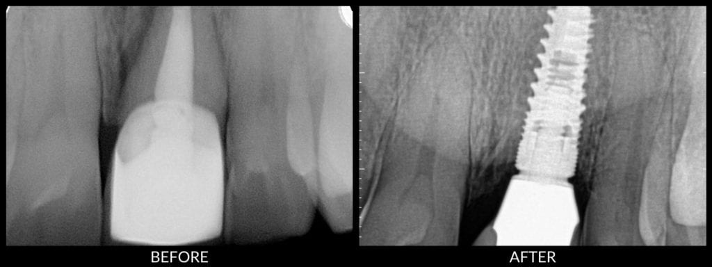 dental implants before and after xrays