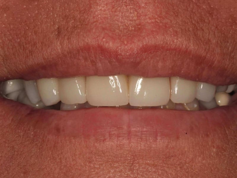 dental veneers after photo
