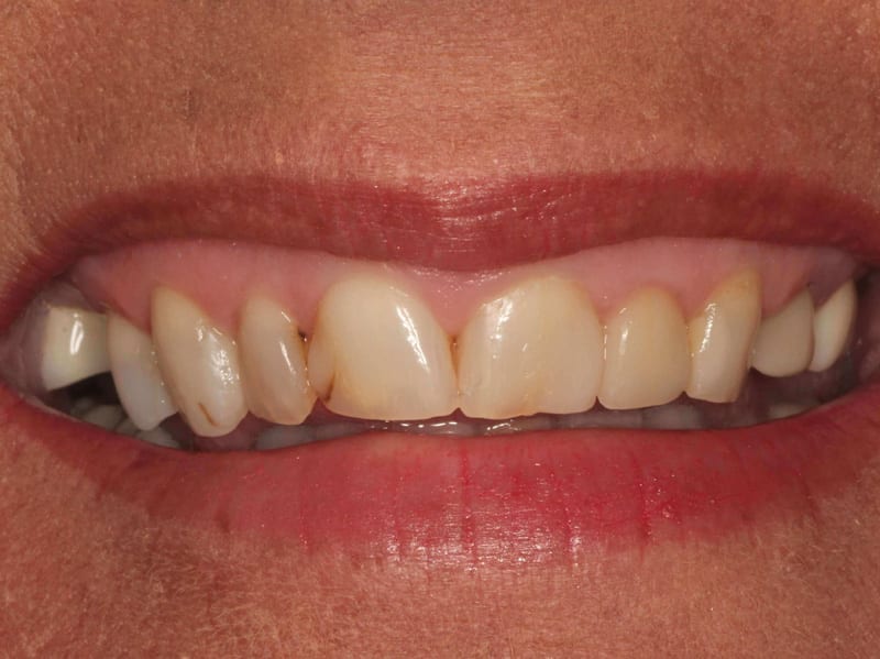 dental veneers before photo