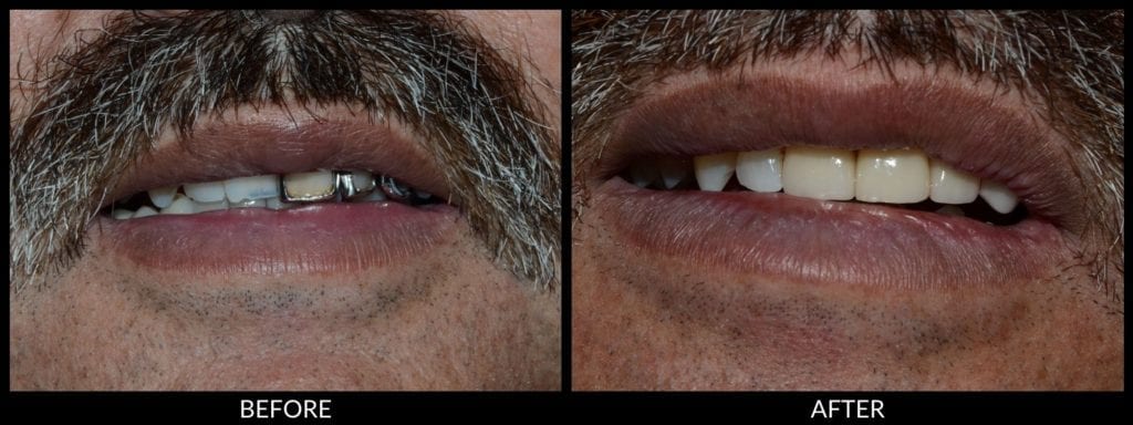 dental veneers before and after photo