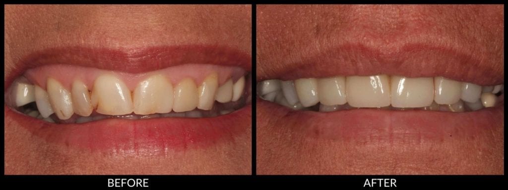 dental veneers before and after photo