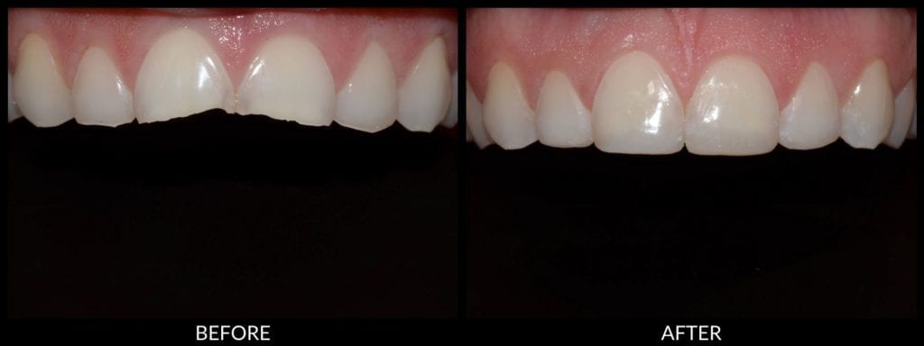dental veneers before and after photo