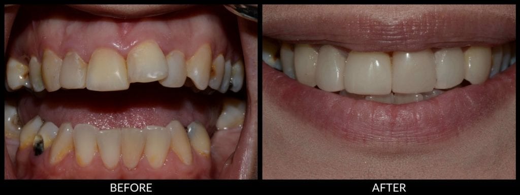 dental veneers before and after photo